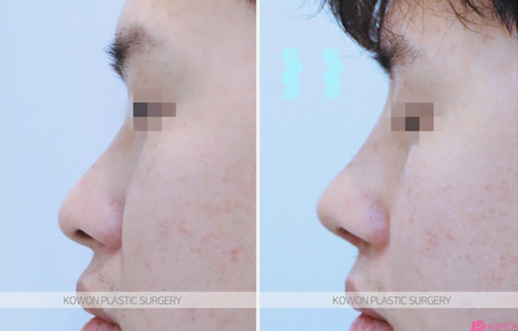 Q. Can a large nose be improved with nasal bridge osteotomy and tip surgery? (Question about male rhinoplasty before and after) image 8