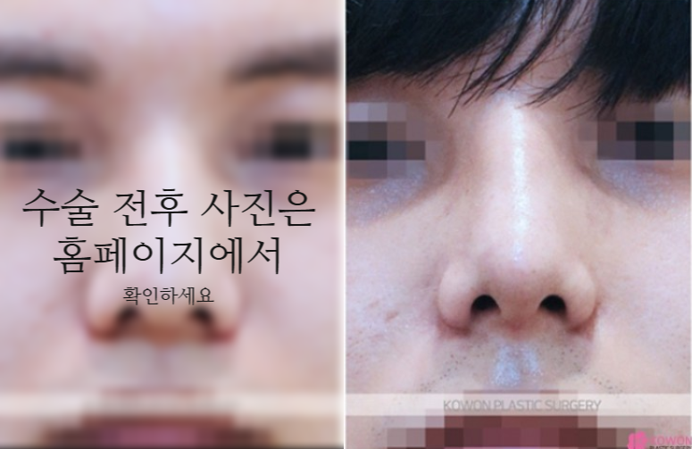 The Recovery Period After Deviated Septum Surgery and 3 Key Factors Determining Male Nose Balance image 8
