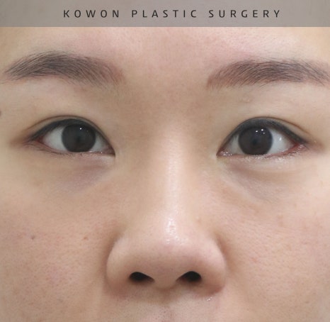 자가늑 코재수술로 비순각수술을 해서 저에게 어울리는 코를 찾았어요! 관련 이미지 6