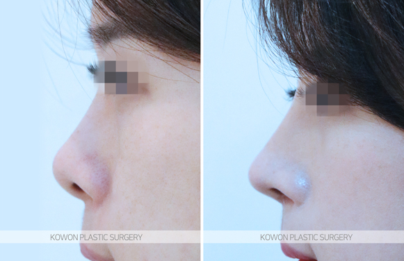 Q. How can I tell capsular contracture in the nose from scar tissue? My nose looks asymmetrical image 3