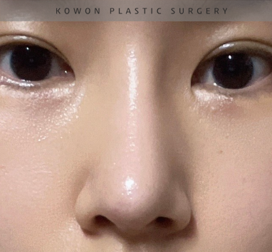 과도하게 화려한코, 귀연골에 비중격코수술로 자연스럽게 개선 됐어요! 관련 이미지 23