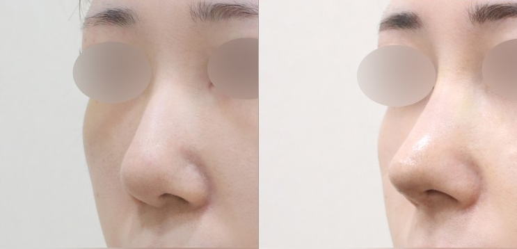Q. 매부리코 깎고 코수술 통증, 코수술 염증인가요? 관련 이미지 3