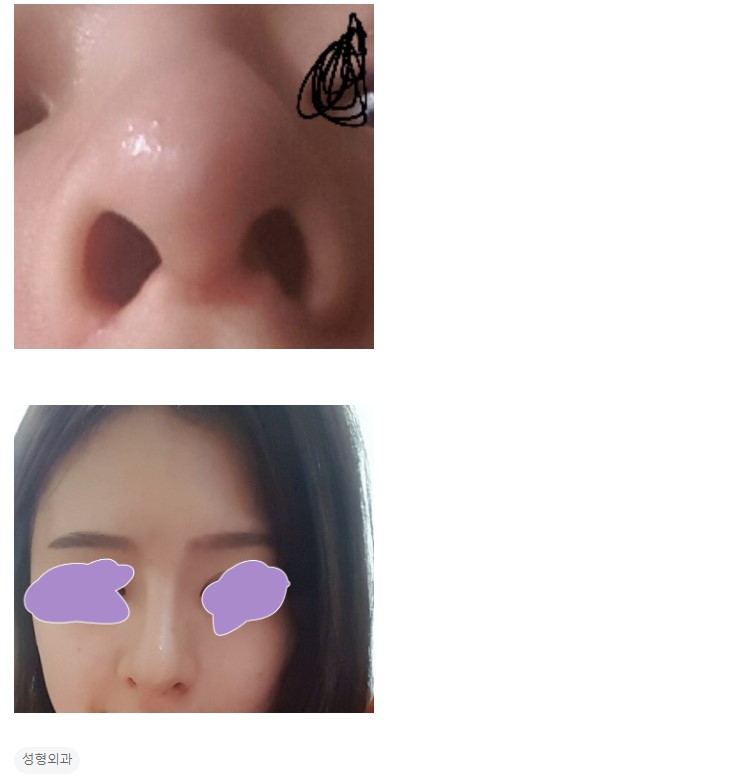 Q. 수술한지 2개월, 코재수술 하고 싶어요. (비중격연골 문제) 관련 이미지 3