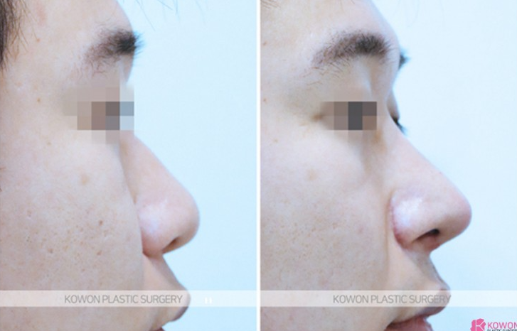 Q. Cartilage Pain After Nose Surgery: Is It a Side Effect of Male Rhinoplasty? Causes and How to Handle It image 10