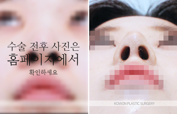 비순각교정 VS 단순 코높임 차이점과 회복에 대하여 관련 이미지 6