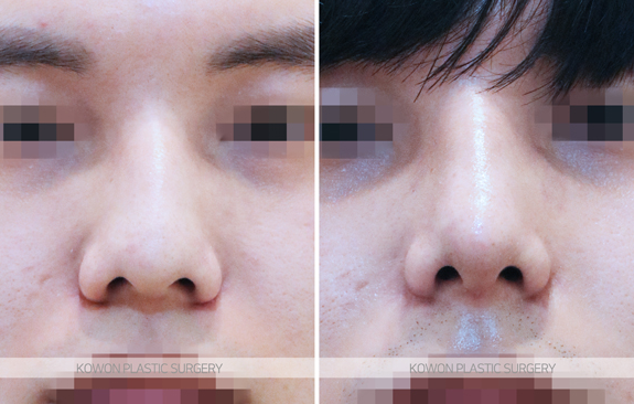 What Are the Criteria for Choosing a Good Place for Men’s Rhinoplasty? A Summary of Changes Before and After a Hump Nose Correction image 5