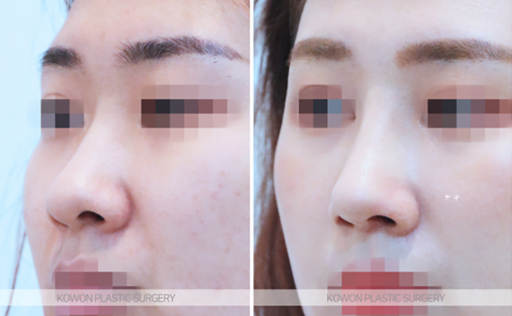 Q. I’m worried because of the difference before and after nostril reduction surgery image 7