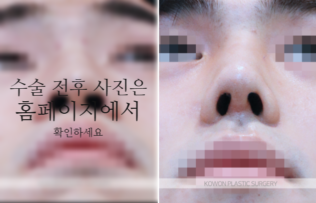 남자매부리코 교정, 비중격만곡증까지 함께 고려해야 하는 이유 관련 이미지 7