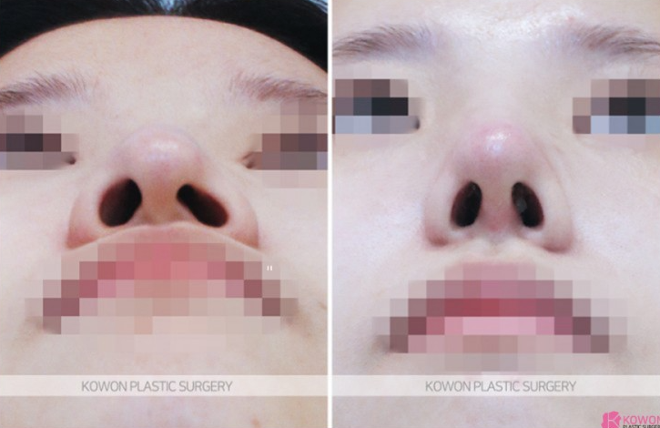 Q. 코수술 후 음주, 코끝 당김이 코염증 증상인가요? 관련 이미지 5
