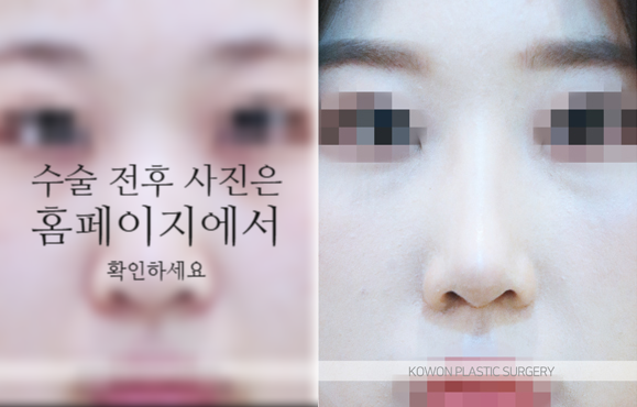 비순각교정 VS 단순 코높임 차이점과 회복에 대하여 관련 이미지 7