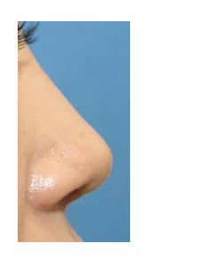 Q. 코끝재수술, 웃을 때 화살코 되는 뭉툭한 코끝은 어떻게 하나요? 관련 이미지 5