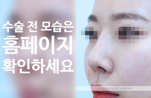 약해진 연골 구조 개선과 코끝 연골재배치로 보는 코재수술 성형외과 성공 사례 관련 이미지 3