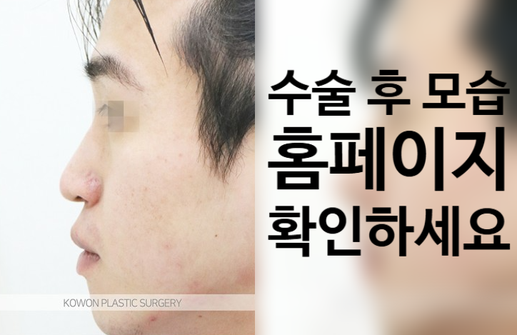 코원성형외과 리브핏으로 완성하는 남자 코끝 성형 및 콧대 라인 교정 관련 이미지 3