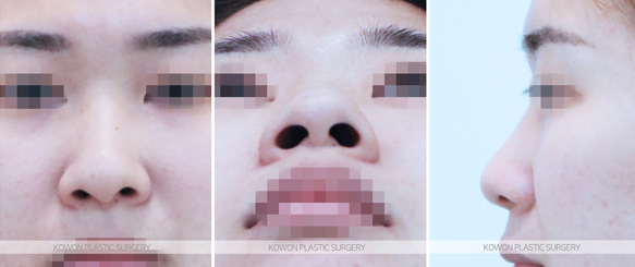 코끝연골재배치 어떤 변화가 나타날까요? 복코 라인 개선 과정 정리 관련 이미지 4