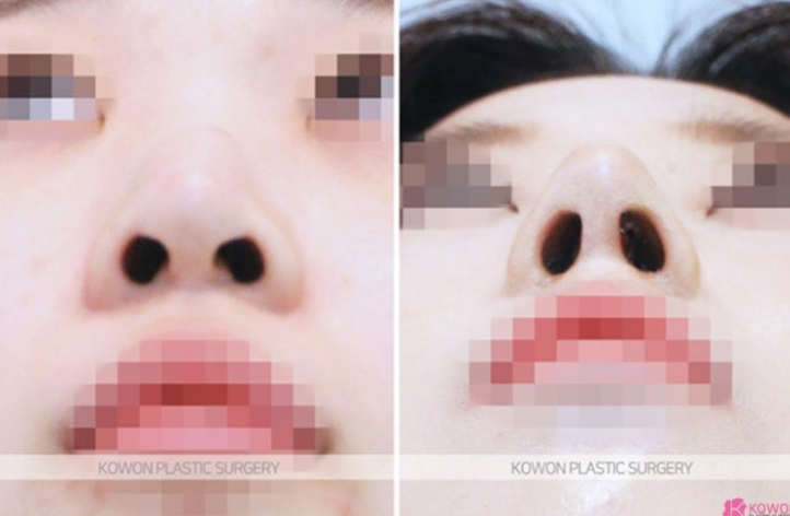 Q. Rhinoplasty precautions: After nose surgery, is it okay if my glasses press on my nose? image 5