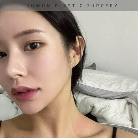 과도하게 화려한코, 귀연골에 비중격코수술로 자연스럽게 개선 됐어요! 관련 이미지 28