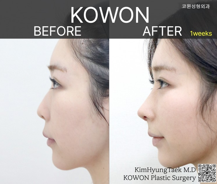 A Surgical Approach to a Drooping Tip and Long-Nose Appearance with Implant-Free Rhinoplasty image 3