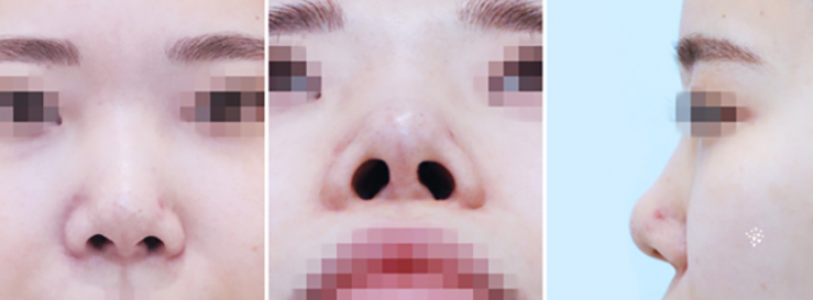 Q. Why Do the Nostrils Look Uneven After Revision Nose Surgery with Ear Cartilage? image 5