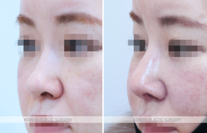 Q. I heard that 10 years after nose surgery, revision surgery is mandatory. Is that true? image 6