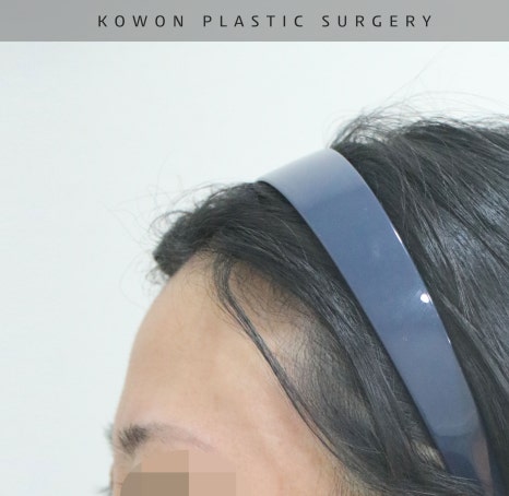 This is a review of nose surgery for a bulbous nose using donated rib cartilage at Kowon Plastic Surgery! image 18
