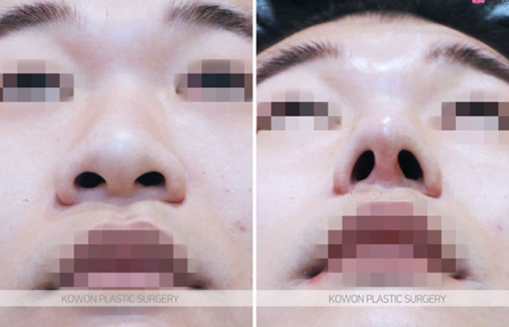 주먹코 수술 언제 자연스러워지나요? 직후 변화와 회복기간 정리 관련 이미지 5