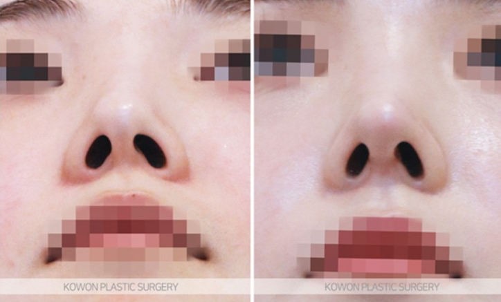 Q. I want to improve my nostrils without artificial implants in upturned nose surgery image 7