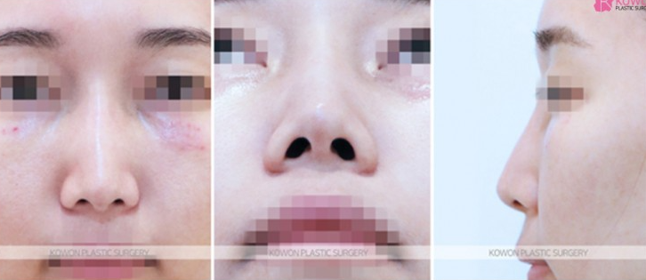 Q. Considering Surgery for the Bridge Between the Eyebrows and the Nose: Side Effects of Nasal Bridge Surgery and Key Points for Revision Surgery image 5