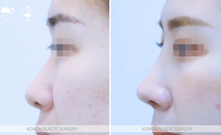 Q. Worried about inflammation after nose surgery, is severe pain after suture removal normal? image 8
