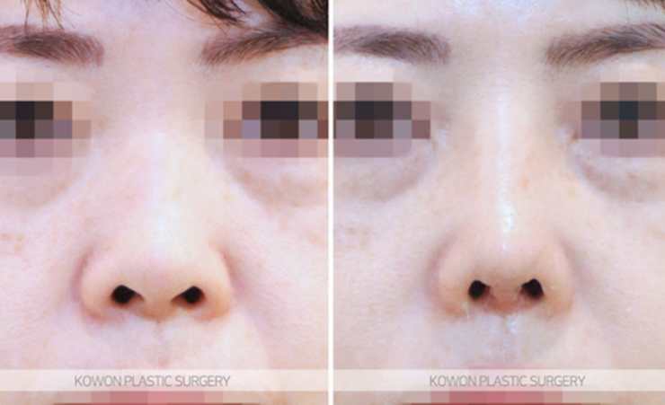Q. I’m considering nose surgery in Seoul, and I have questions about the methods and safety of rhinoplasty image 8