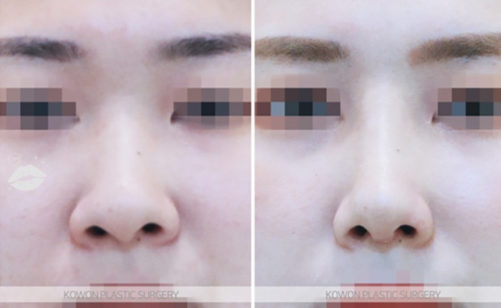 Q. 코수술 부작용일까요? 안경을 착용하면 통증이 느껴져요 관련 이미지 7