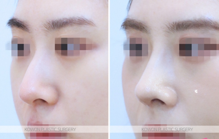 Q. Which is the right choice: nasal osteotomy or tip elevation in nose surgery? image 6