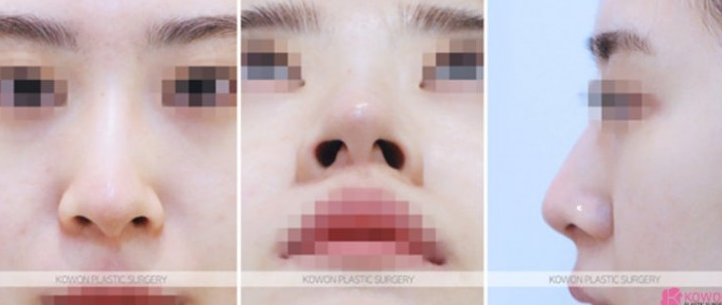 Q. Is non-open nose surgery possible? A complete guide to concerns about general anesthesia image 4