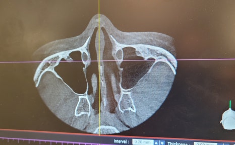This is a review of nose surgery for a bulbous nose using donated rib cartilage at Kowon Plastic Surgery! image 12