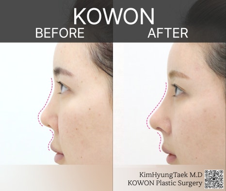 코원성형외과 코재수술성형외과에서 자가늑코재수술로 원하는 코를 주셨어요! 관련 이미지 19