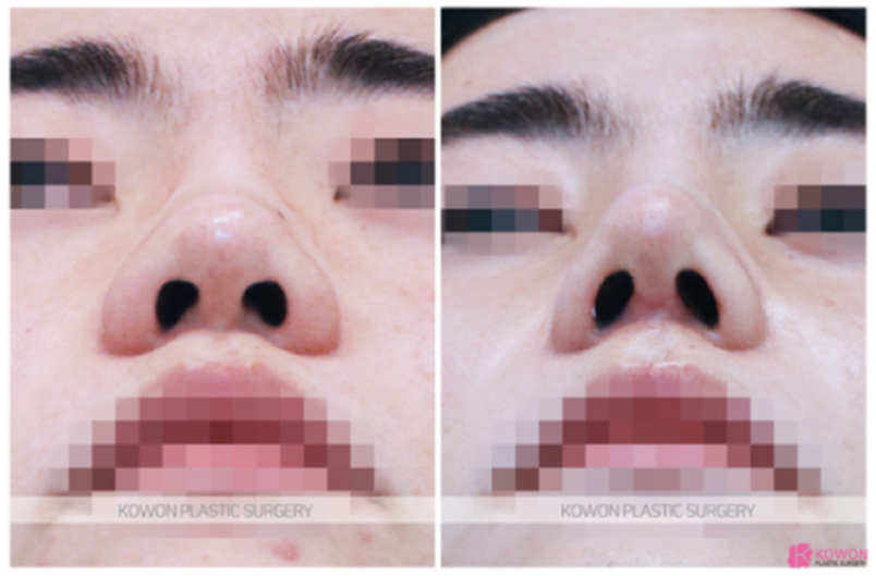 코원성형외과 복코 교정 직후의 변화와 뚱뚱한 코 복코 교정 노하우 관련 이미지 3