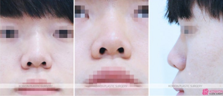 Q. 남자 매부리코수술 어떤 수술 방식이 좋을까요? 관련 이미지 3