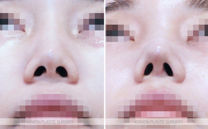 What Is Refined Natural Nose Surgery? Check This If You’re Considering Small Nose Surgery image 8