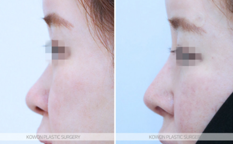 Natural Nose Line Improvement Process Seen Through Changes Before and After Cartilage Stitching at the Nasal Tip image 9