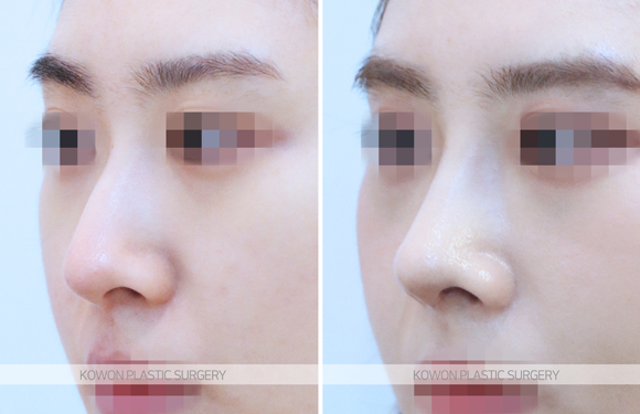 Q. Would nose fat-dissolving injections be effective? I’m wondering whether bulbous nose surgery or tip surgery is necessary image 4