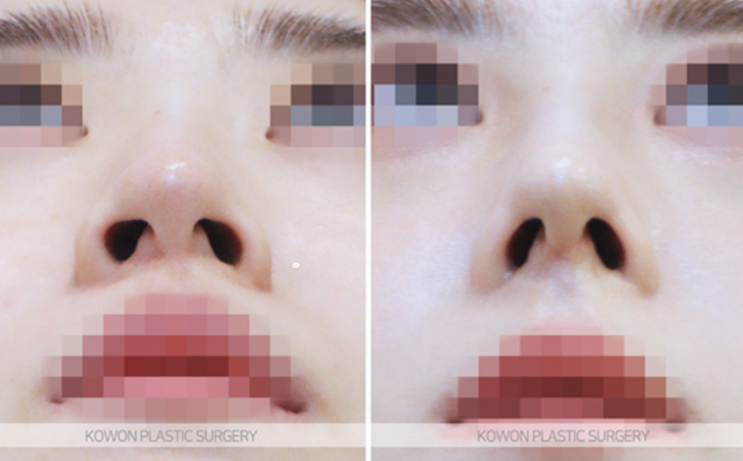 Low Nose Rhinoplasty: A Change to a More Three-Dimensional Impression, 3 Questions About Tip Cartilage Repositioning image 10
