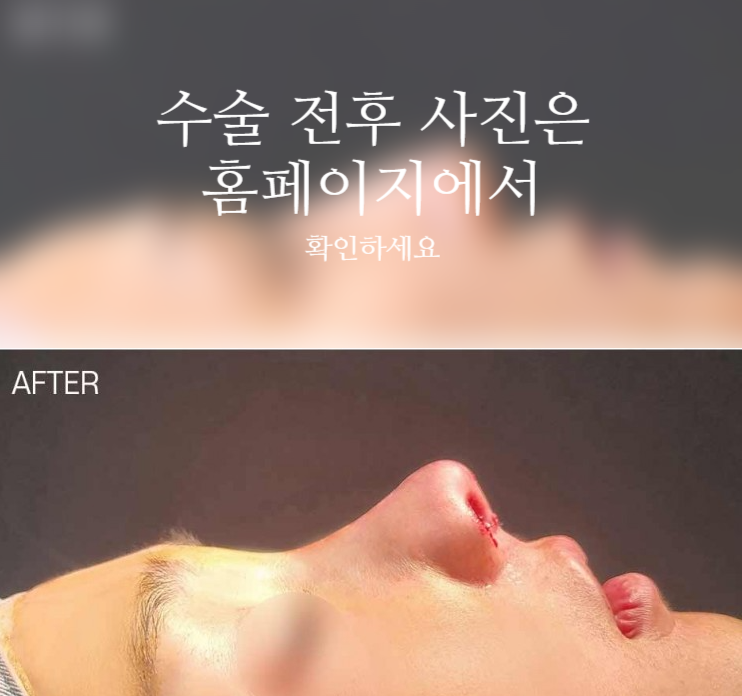 자가늑 코성형으로 코끝 처짐과 구조를 함께 고려해야 하는 이유 관련 이미지 2