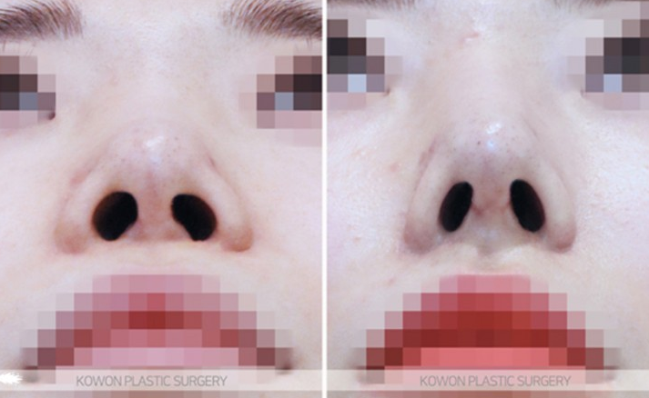 Q. If You’re Considering Revision Rhinoplasty image 8