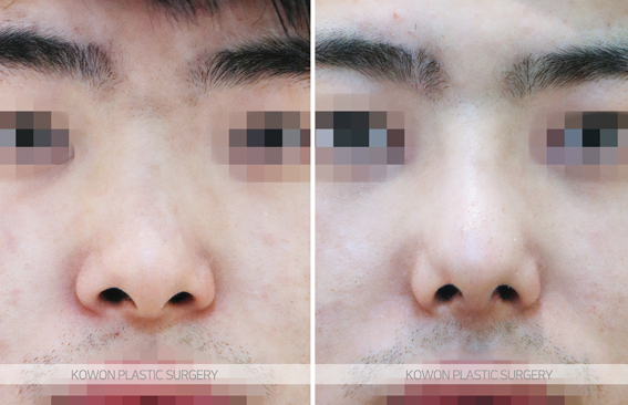 Q. 비중격만곡증 수술 경험 후 복코 관련해서 남자코성형 고민입니다. 관련 이미지 4