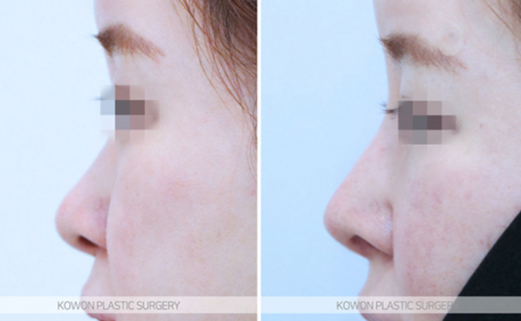 Q. I’m wondering whether my nose surgery swelling period needs more time to look natural, or whether revision surgery is necessary. image 9