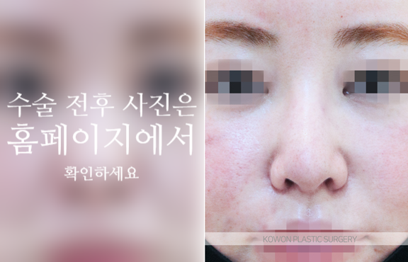 자가늑 코성형으로 코끝 처짐과 구조를 함께 고려해야 하는 이유 관련 이미지 5