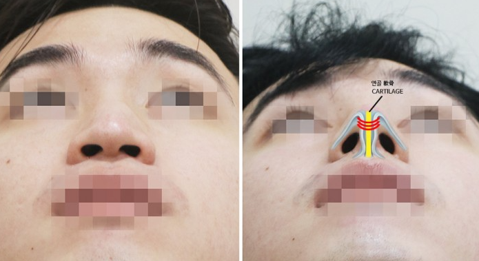 남자코성형전후 매부리코 수술에서 콧대와 코끝을 함께 보는 이유 관련 이미지 5