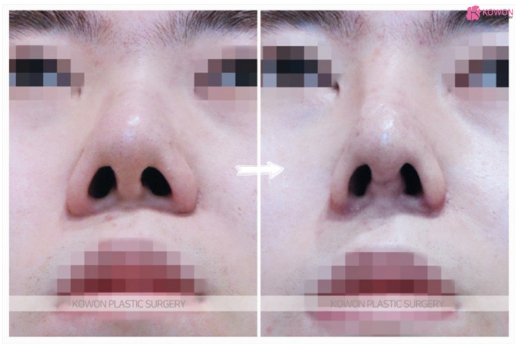 Q. 코 재수술시 일자코로 만들면서 코필러성형도 할수있나요? 관련 이미지 5