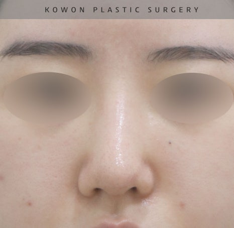 울퉁불퉁해 신경 쓰이던 코를 코원성형외과에서 낮은코와 매부리코교정으로 매끄럽게 만들었어요! 관련 이미지 18