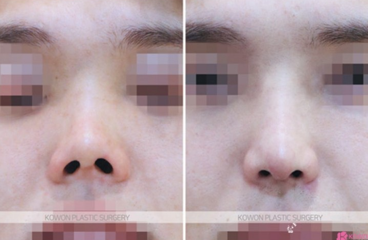 Q. Nasal Surgery Inflammation: Is Gore-Tex Implants with Ear Cartilage at the Tip Okay? image 4