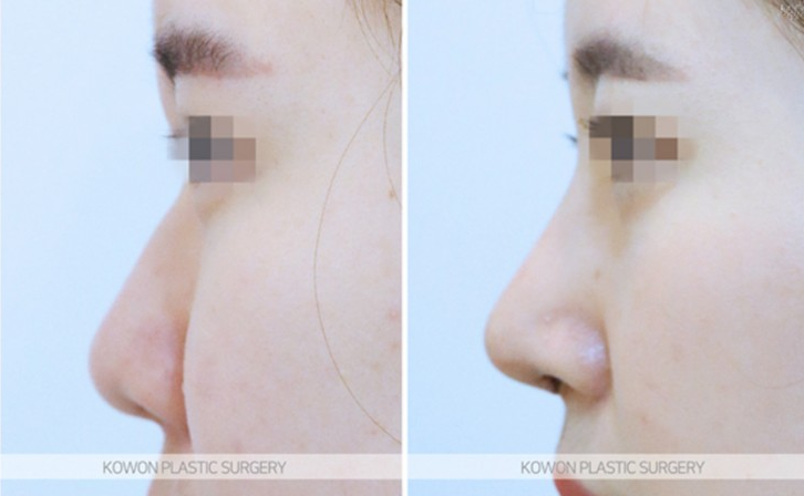 Q. Is Kangnam nose revision surgery necessary for a nose tip surgery complication? image 8